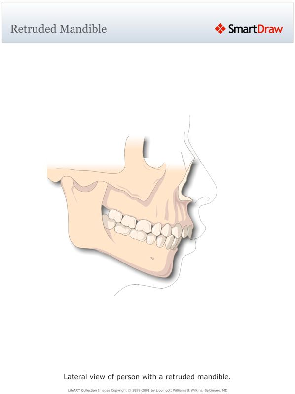 Retruded_Mandible