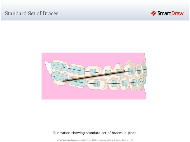 Standard_Set_of_Braces