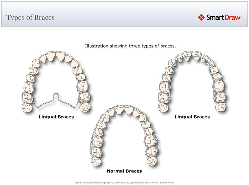 Types_of_Braces