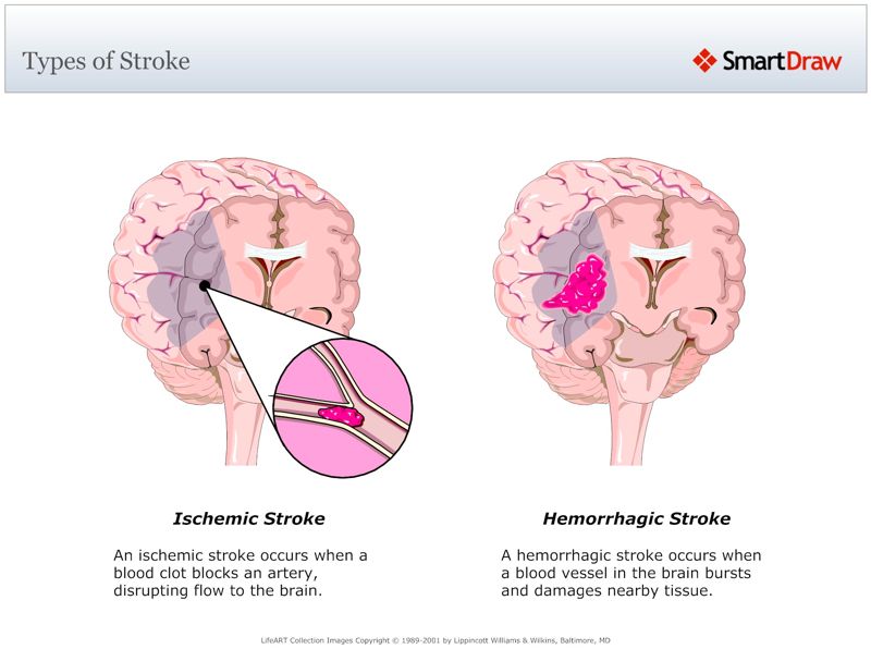 Types_of_Stroke