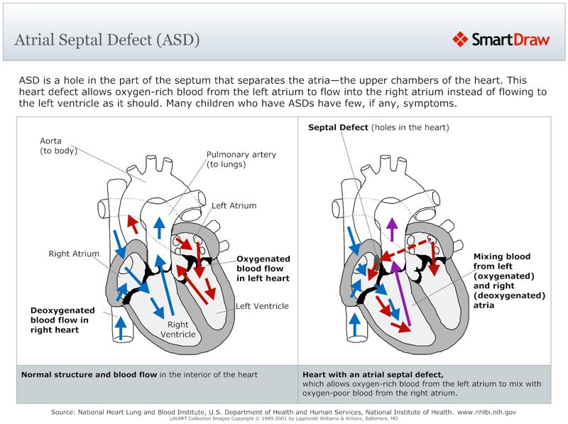 Atrial_Septal_Defect_(ASD)