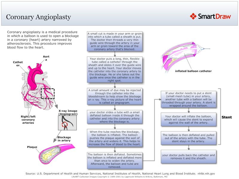 Coronary_Angioplasty