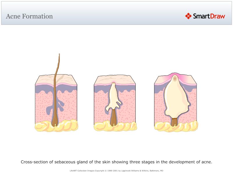 Acne_Formation