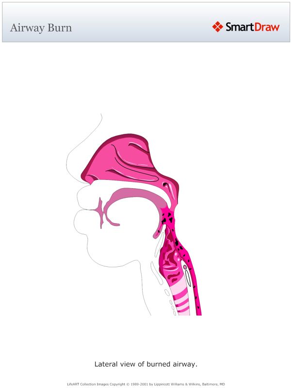 Airway_Burn