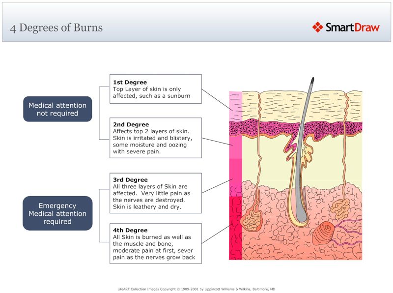 4_Degrees_of_Burns