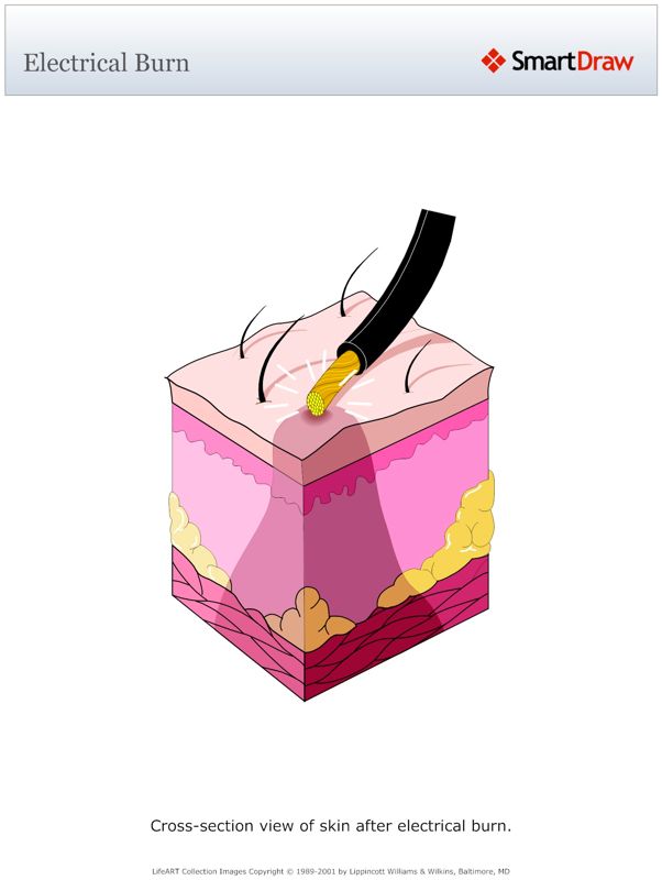 Electrical_Burn