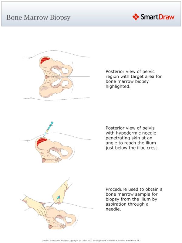 Bone_Marrow_Biopsy2