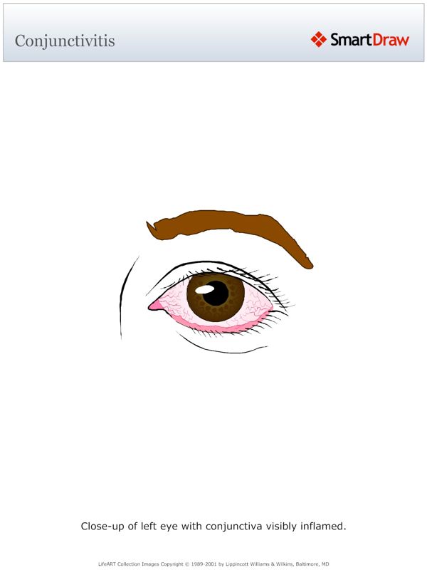 Conjunctivitis