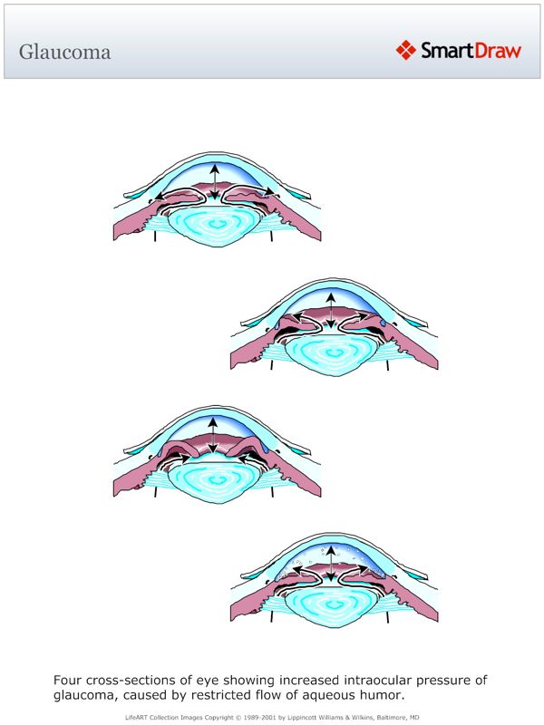 Glaucoma
