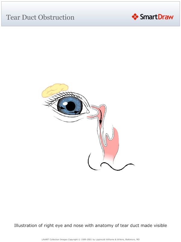 Tear Duct Obstruction