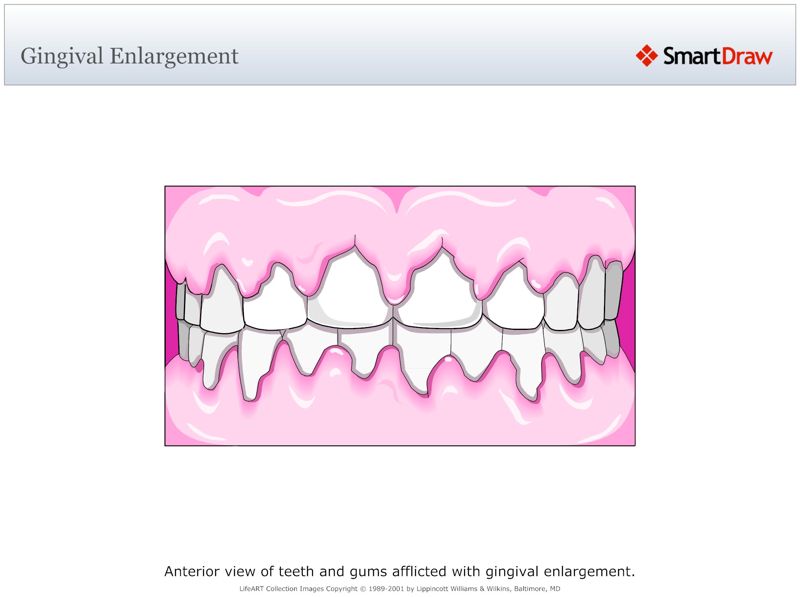 Gingival_Enlargement
