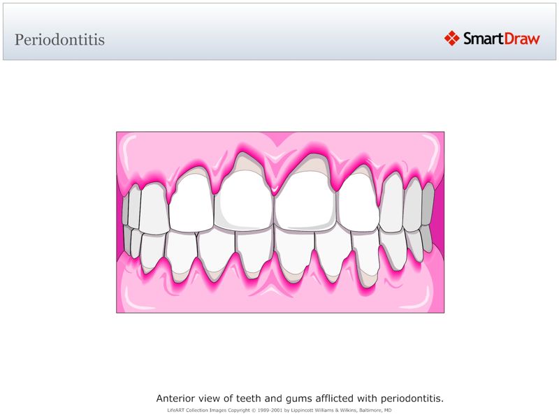 Periodontitis