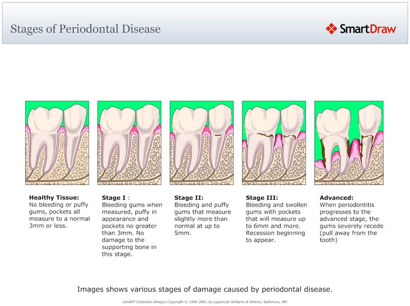 Stages_of_Periodontal_Disease