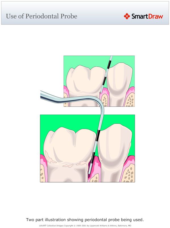Use_of_Periodontal_Probe