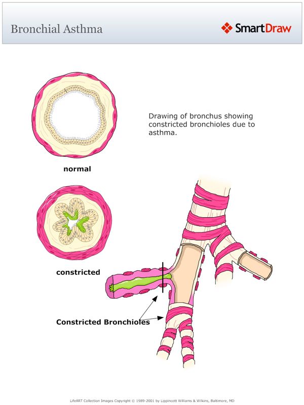 Bronchial_Asthma