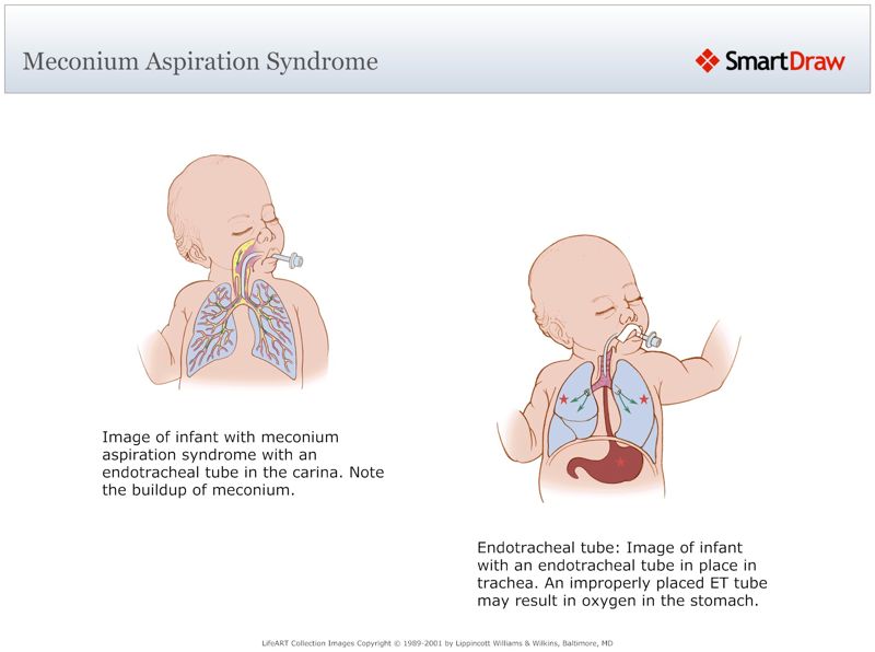 Meconium_Aspiration_Syndrome