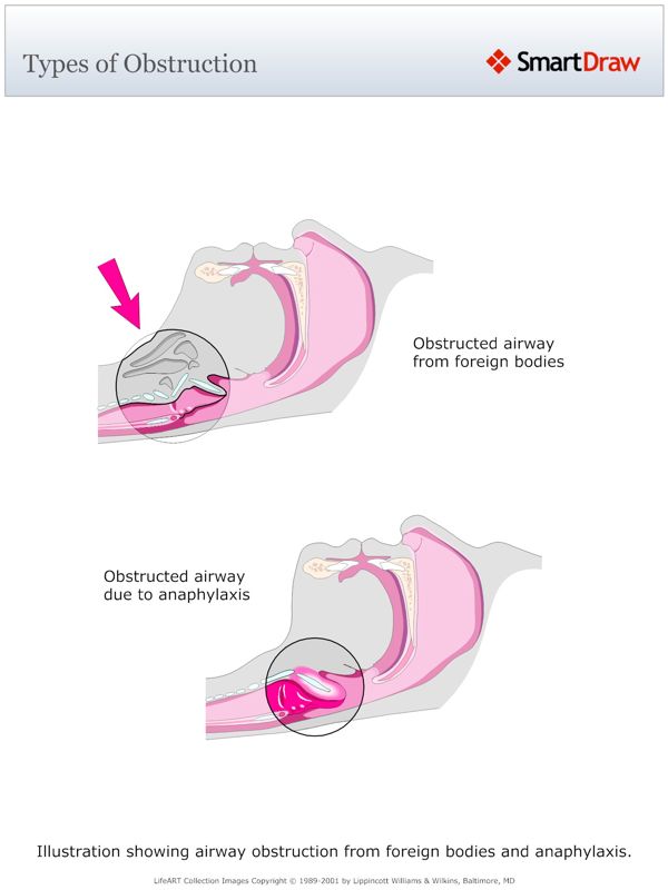 Types_of_Obstruction