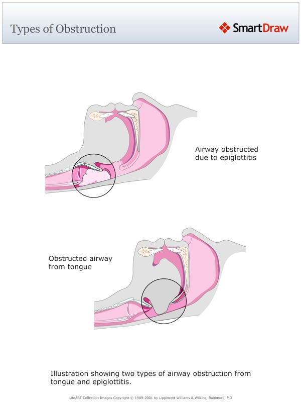 Types_of_Obstruction2