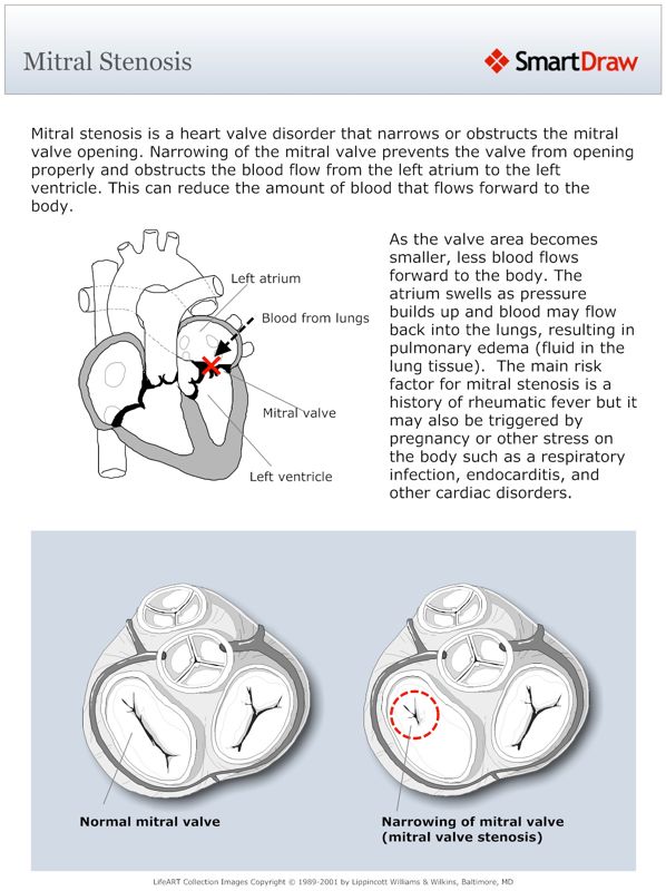 Mitral_Stenosis