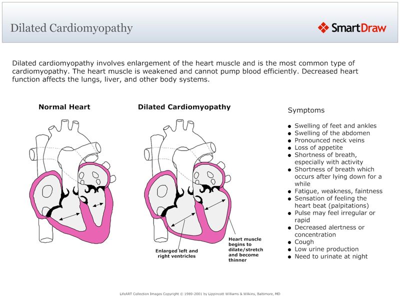 Dilated_Cardiomyopathy