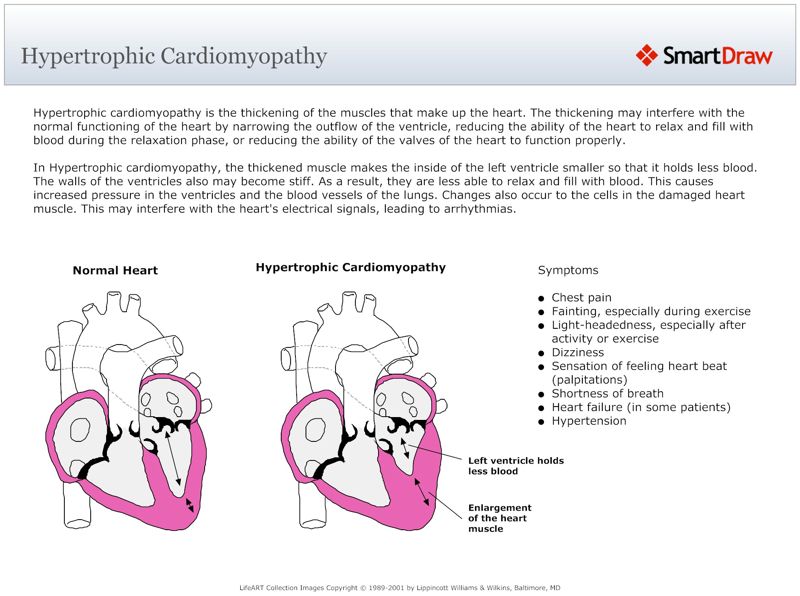 Hypertrophic_Cardiomyopathy