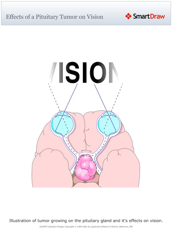 Effects_of_a_Pituitary_Tumor_on_Vision