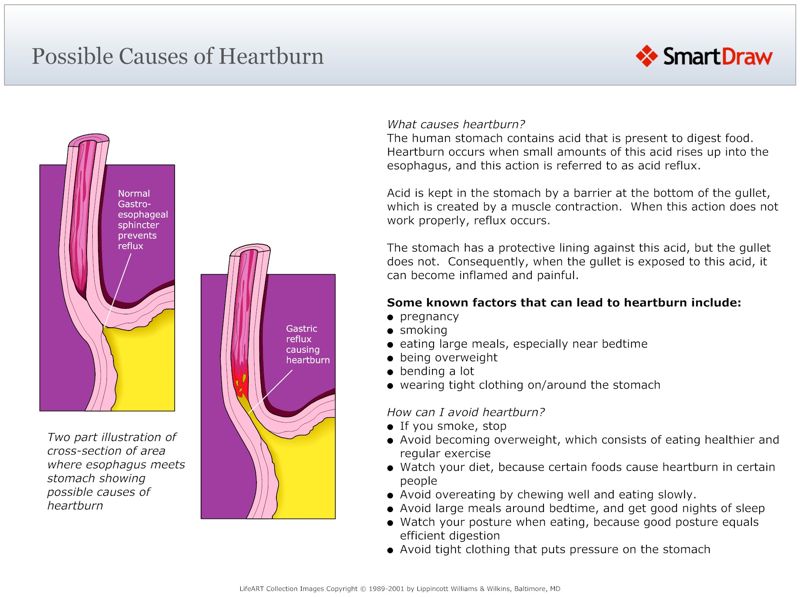 Possible_Causes_of_Heartburn