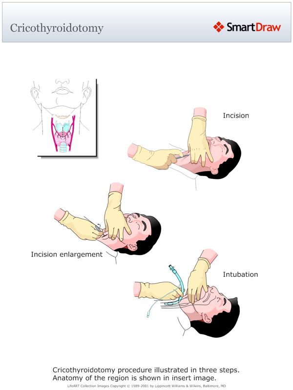 Cricothyroidotomy
