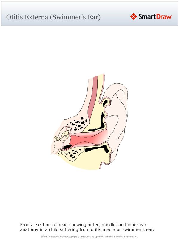 Otitis_Externa_(Swimmer's_Ear)