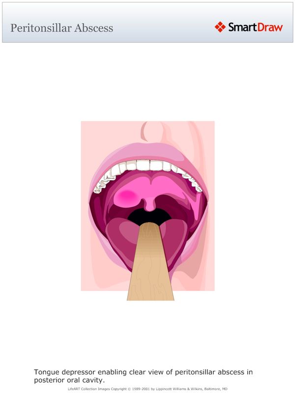 Peritonsillar_Abscess
