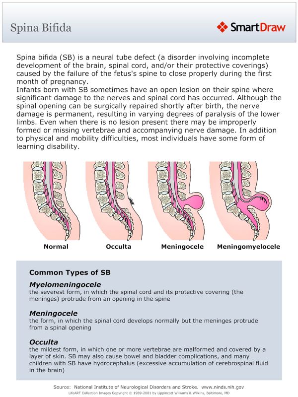 Spina_Bifida