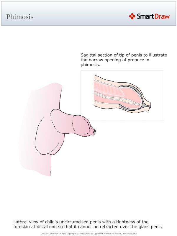 Phimosis
