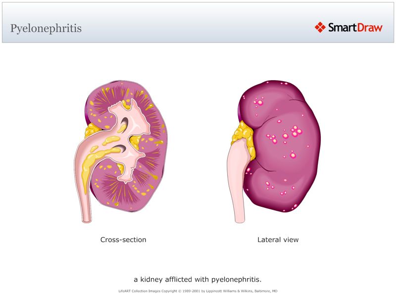 Pyelonephritis