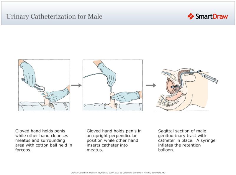 Urinary_Catheterization_for_Male