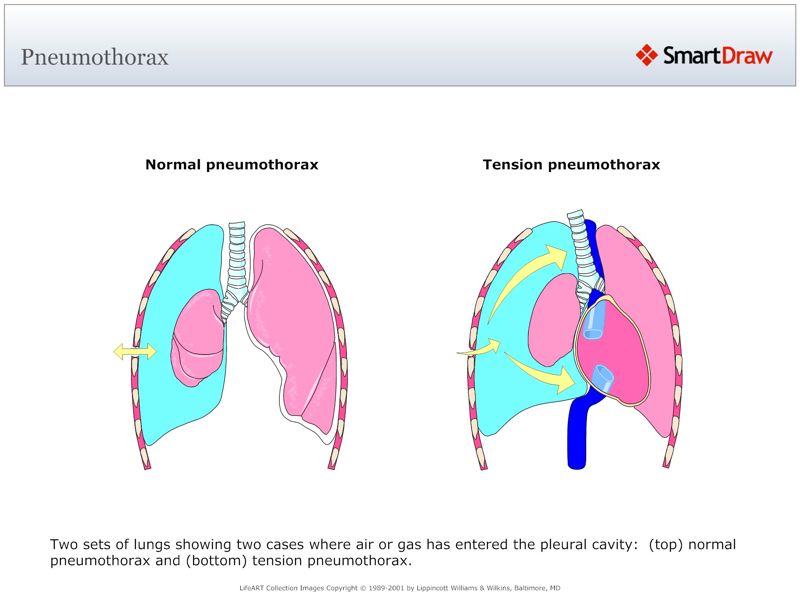 Pneumothorax