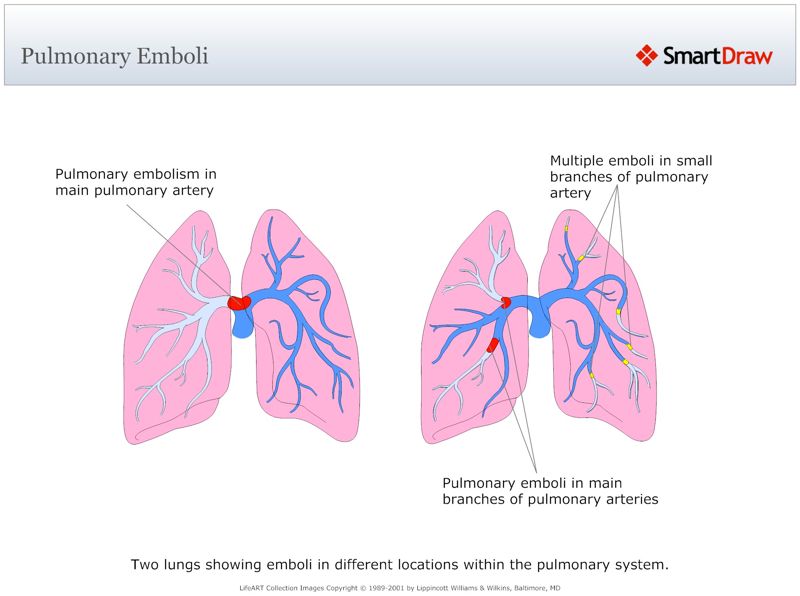 Pulmonary_Emboli