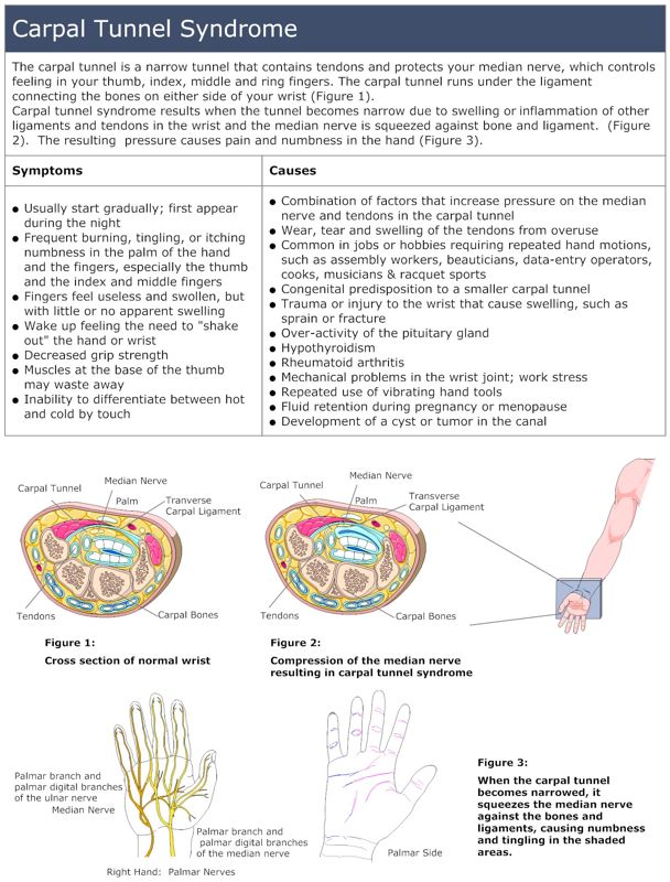 Carpal_Tunnel_Syndrome