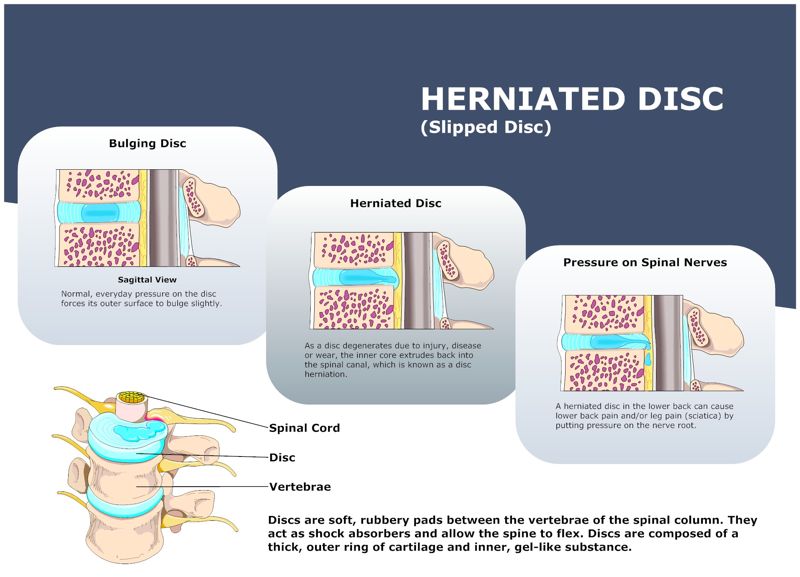 HERNIATED_DISC