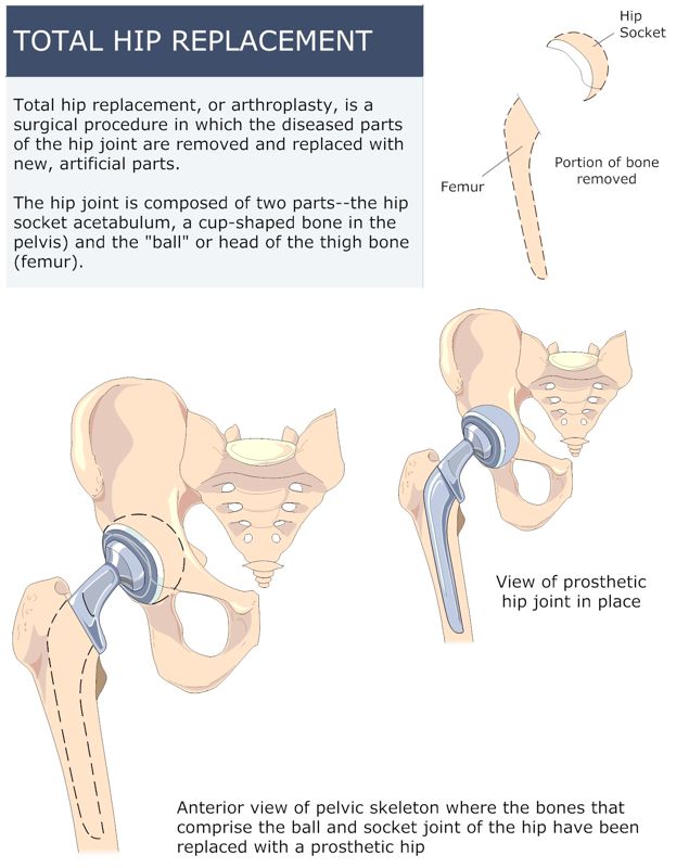 TOTAL_HIP_REPLACEMENT