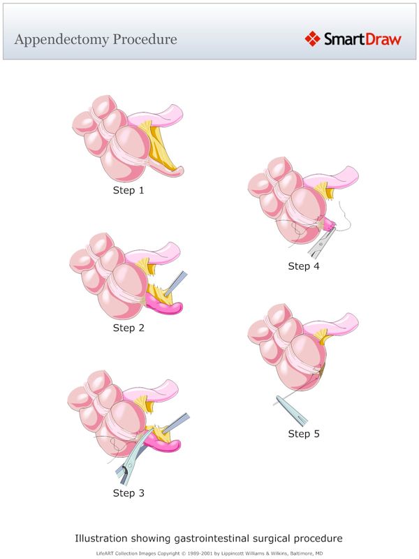 Appendectomy_Procedure