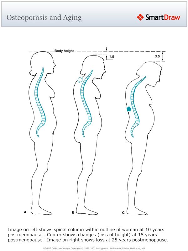 Osteoporosis_and_Aging