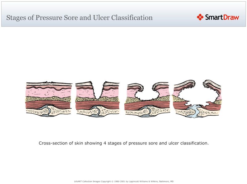 Stages_of_Pressure_Sore_and_Ulcer_Classification