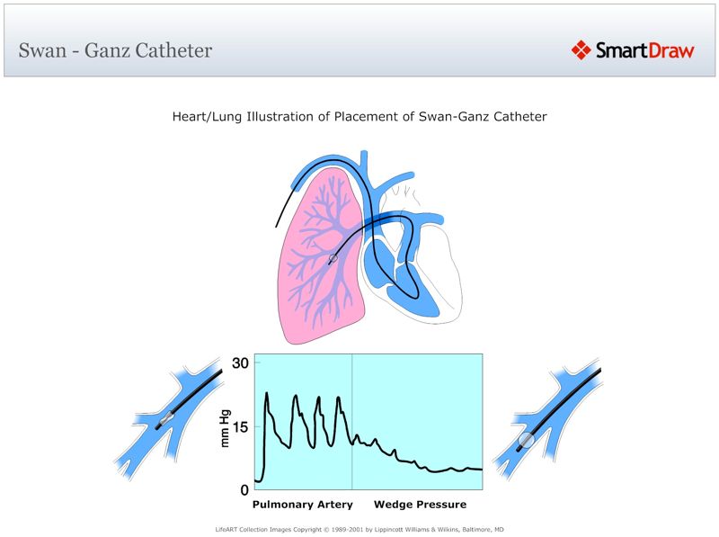Swan_-_Ganz_Catheter