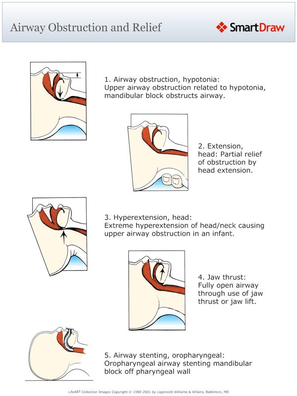 Airway_Obstruction_and_Relief