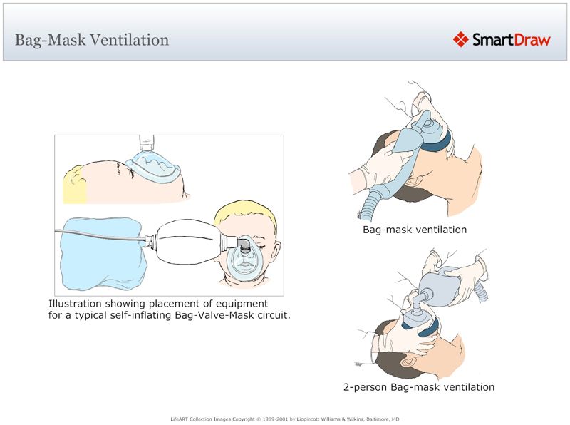 Bag-Mask_Ventilation