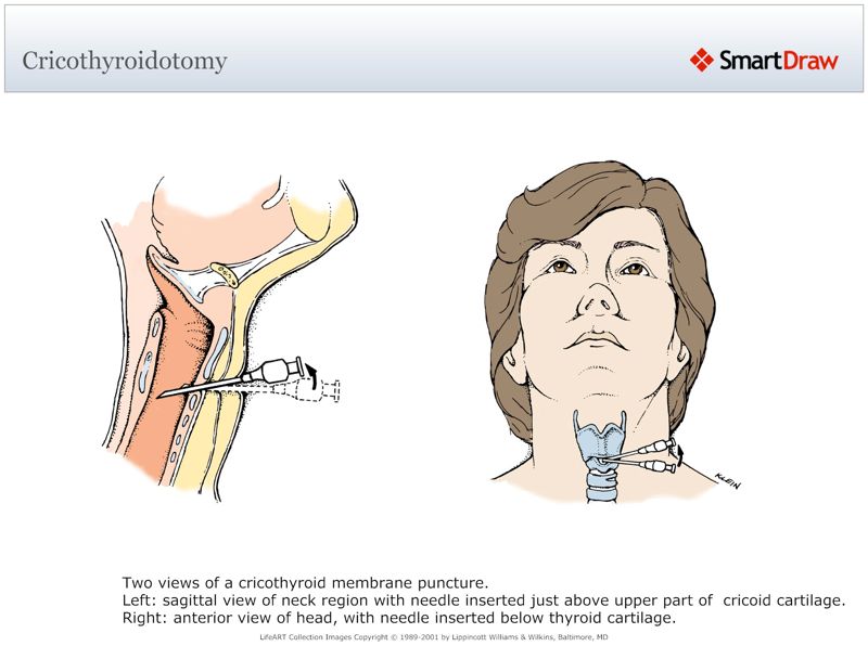 Cricothyroidotomy