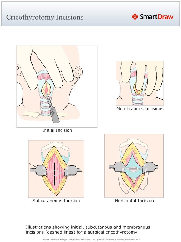 Cricothyrotomy_Incisions