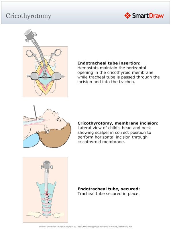 Cricothyrotomy