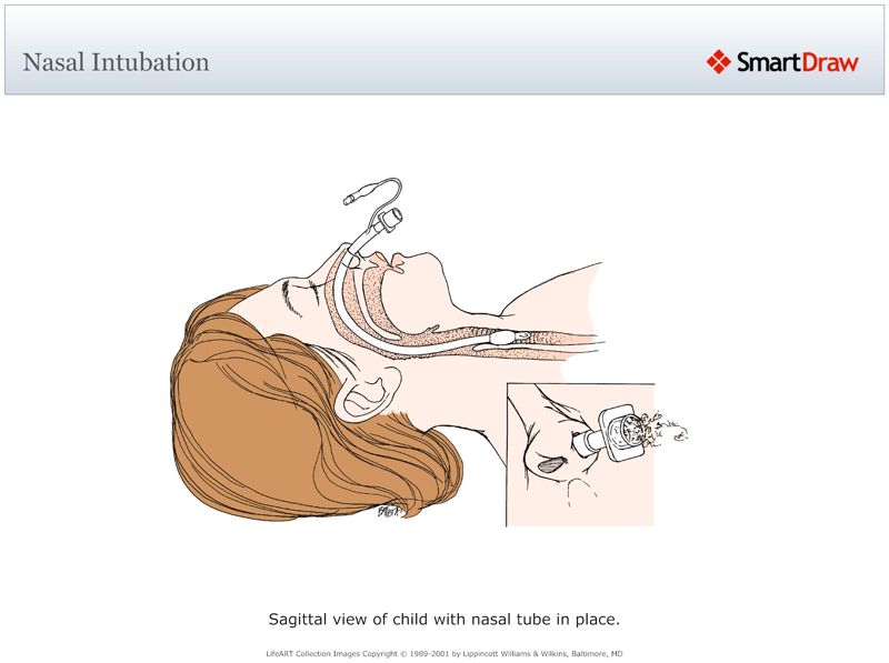 Nasal_Intubation