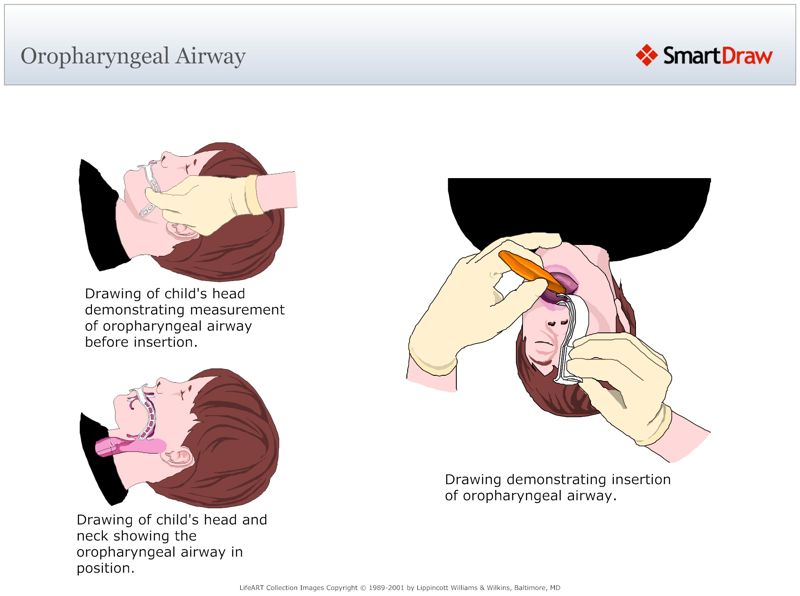 Oropharyngeal_Airway
